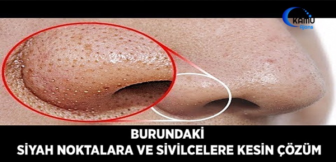 Burundaki Siyah Noktalara ve Sivilcelere Kesin Çözüm