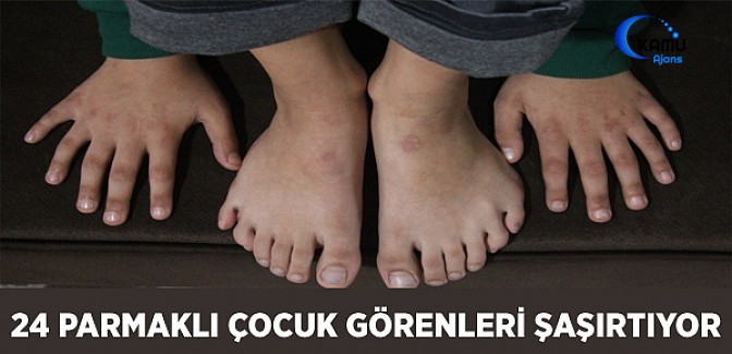 24 Parmaklı Çocuk Görenleri Şaşırtıyor