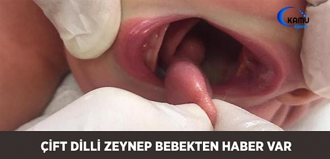 ''Aksesuar Dil'' Çift Dilli Zeynep Bebek Sağlığına Kavuştu