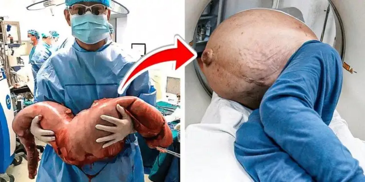 Doktorlar Adamın Karnında 30 Kiloluk İlginç Bir Şey Keşfetti Acil Ameliyata Aldılar